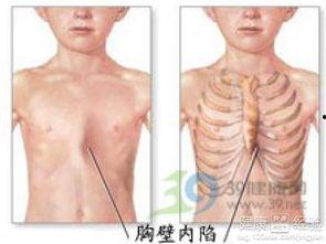 成人鸡胸怎么矫正图片视频,图片与视频详解
